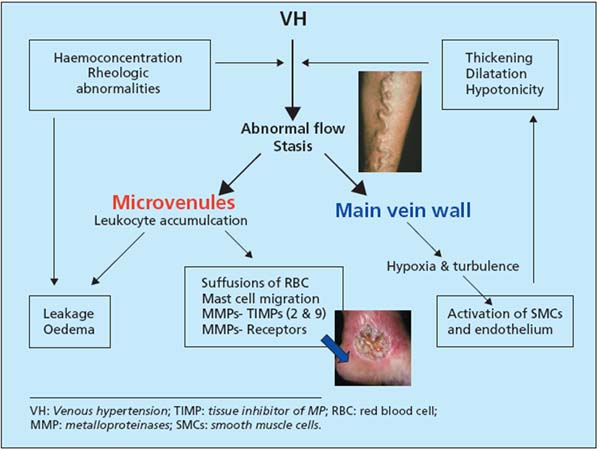 Mechanisms of onset of chronic venous insufficiency (CVI