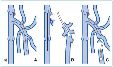 History of venous surgery (1) - Servier - PhlebolymphologyServier ...