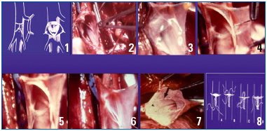 History of venous surgery (3) - Servier - PhlebolymphologyServier