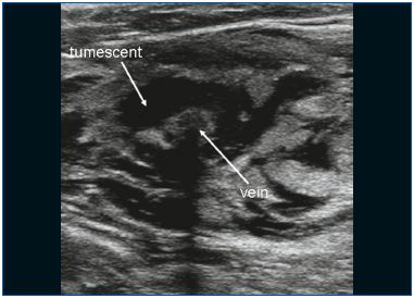 Endovenous thermal ablation for varicose veins: strengths and ...