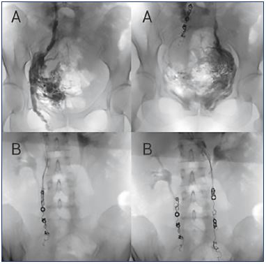 Clinical aspects of pelvic congestion syndrome - Servier -  PhlebolymphologyServier – Phlebolymphology