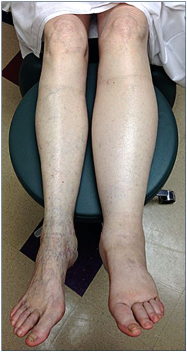 Pathophysiology of edema in patients with chronic venous
